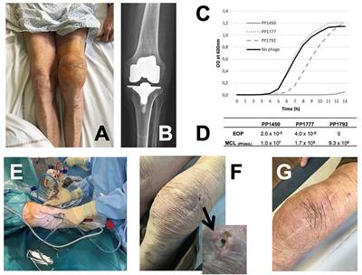 Case Report: Arthroscopic “Debridement Antibiotics and Implant Retention” With Local Injection of Personalized Phage Therapy to Salvage a Relapsing Pseudomonas Aeruginosa Prosthetic Knee Infection